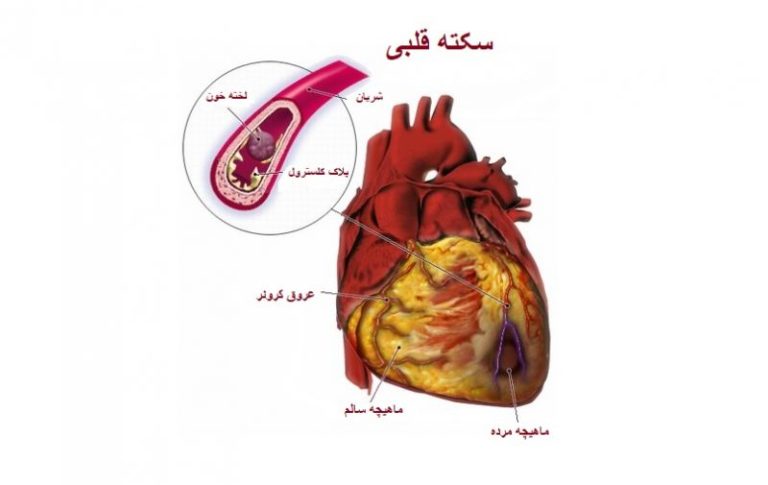 سکته قلبی