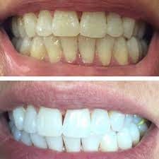 خمیر دندان سفید کننده