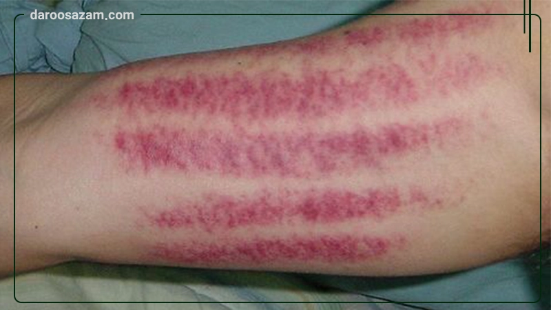 ژل موضعی هپارین فلبرا ایده دارو طب 40 گرم