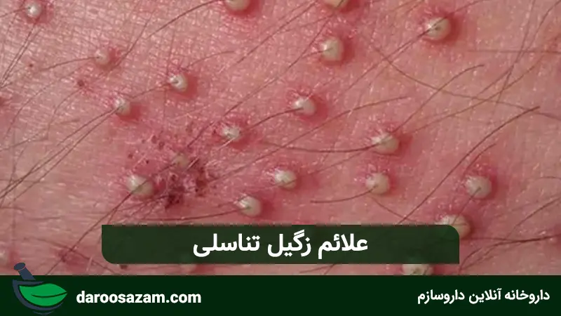 کرم زگیل تناسلی