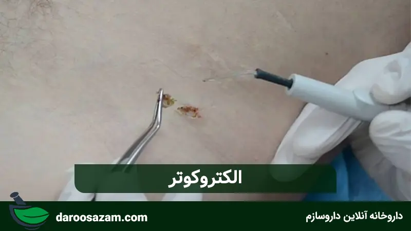 کرم زگیل تناسلی