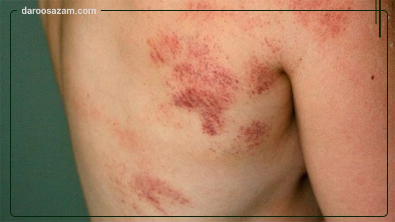 ژل کیتوهیل کیتوتک 30 میلی لیتر
