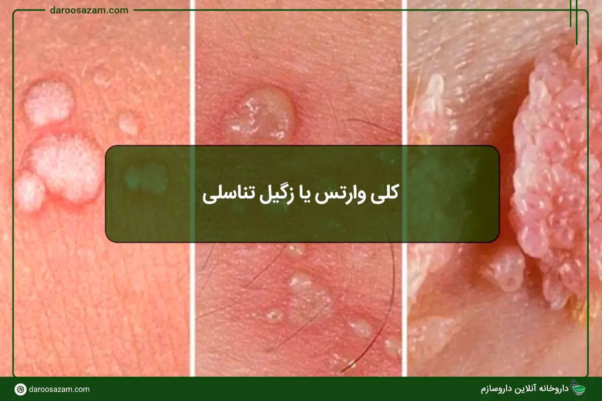 کلی وارتس یا زگیل تناسلی؛ علائم، درمان و روش‌های پیشگیری از