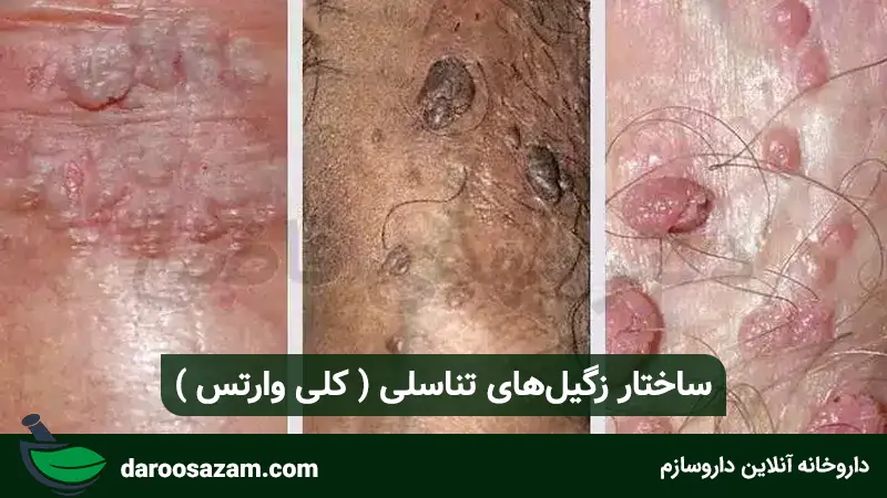 ساختار زگیل‌های تناسلی( کلی وارتس )