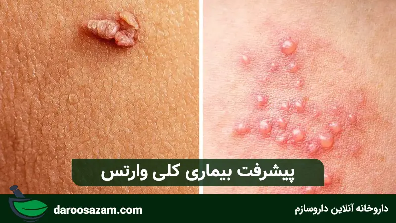 پیشرفت بیماری کلی وارتس