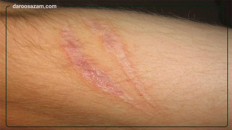 کرم اسکار رژودرم 55 گرمی