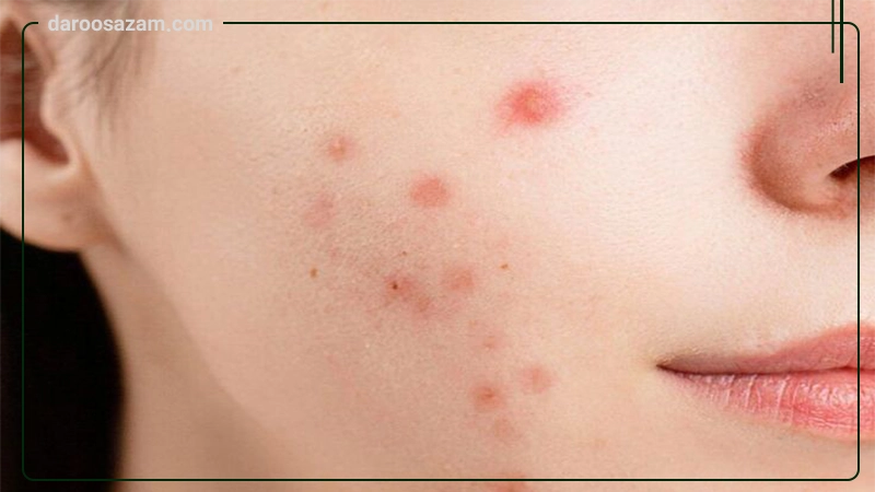 ژل استراتادرم استرات فارما
