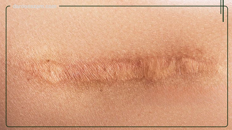 ژل استراتامد استرات فارما 20 گرمی