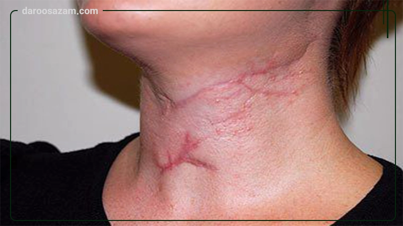 ژل استراتامد استرات فارما 5 گرمی