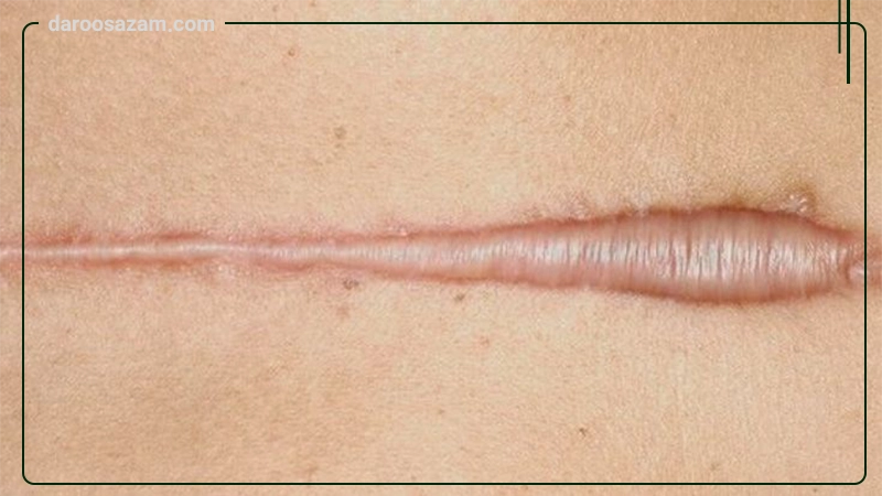 کرم ترمیم کننده اسکار استاتیک رژوا اسکین 10 گرمی