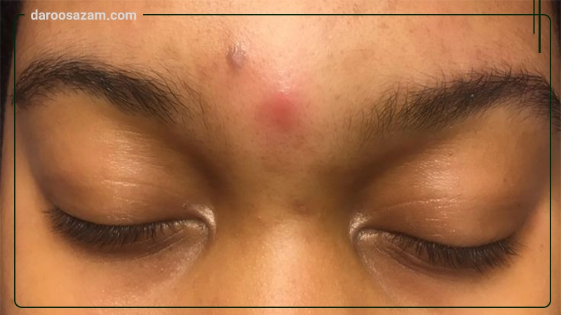 ژل ترمیم کننده رژواسیل رژوا اسکین 10 گرمی