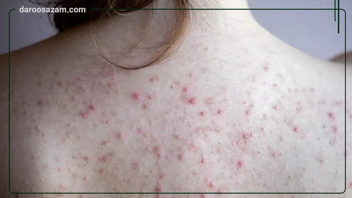 اسپری ضد جوش بدن سالیسیل 2 سبوما آردن