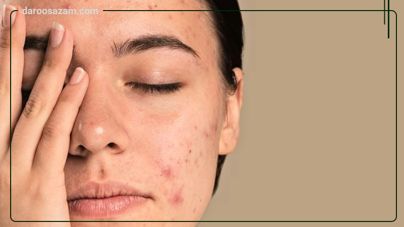 ژل ضدجوش آکنه وست پرودرما 20 میلی لیتر