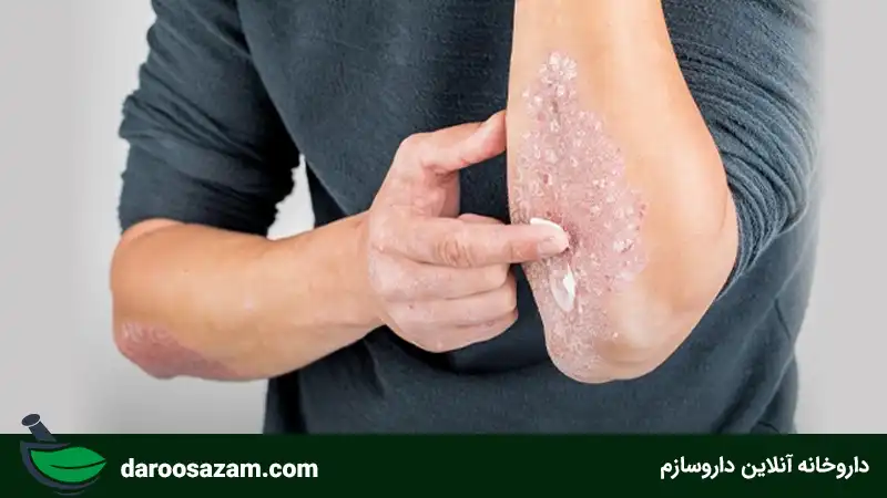 معرفی بهترین کرم درمان پسوریازیس