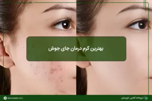 بهترین کرم درمان جای جوش