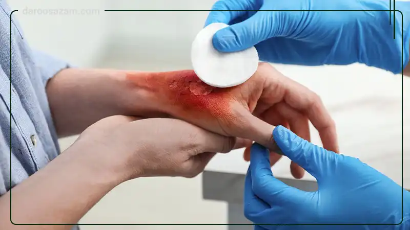 پماد سوختگی