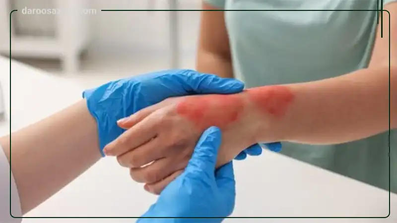 پماد سوختگی