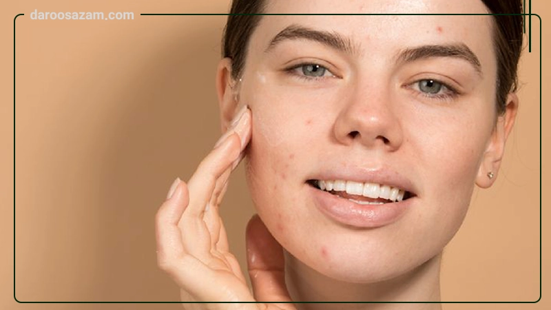ژل ضد جوش و آکنه آکدین