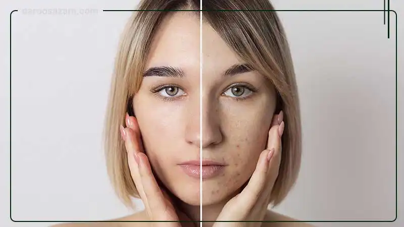 مزایای استفاده کرم ضد جوش